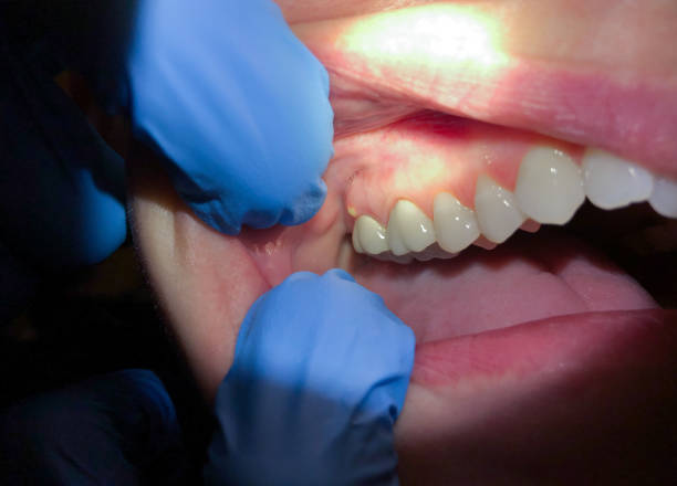 Best Emergency Tooth Extraction in Reno, TX